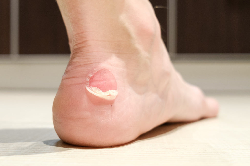 Blisters